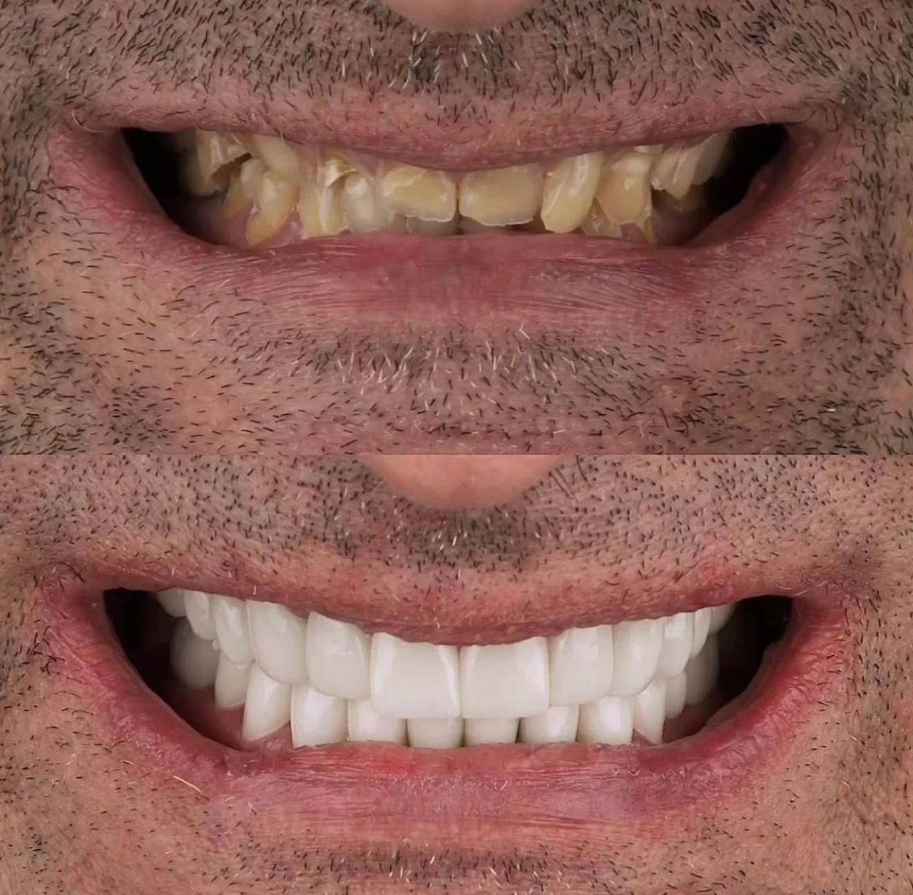 Estética Dental y Carillas