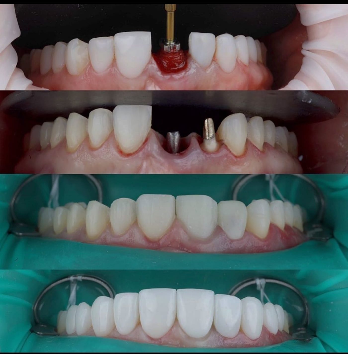 Implantes Dentales